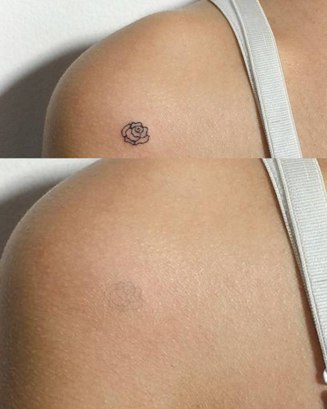 Eliminación tatuajes y lesiones dérmicas