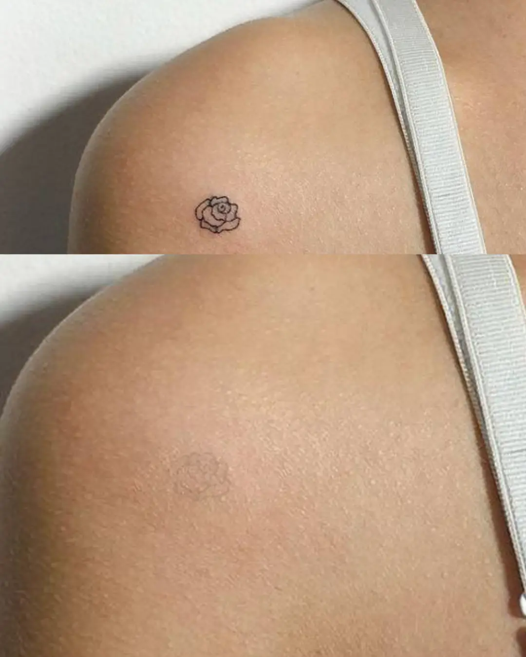 Eliminación de tatuajes y lesiones dérmicas