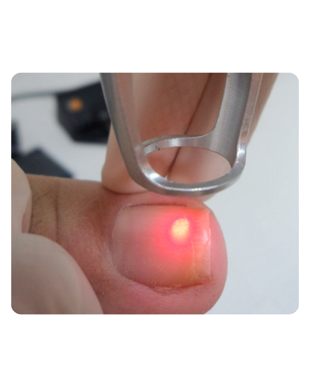 Tratamiento láser para onicomicosis