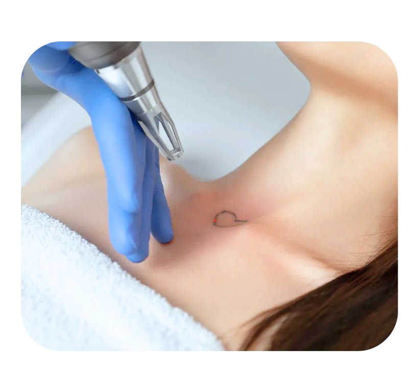 Eliminación de tatuajes y manchas