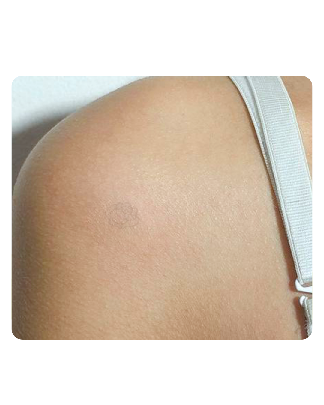 Después eliminación de tatuajes